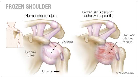 a-medical-illustration-of-a-normal-shoulder-joint-and-one-with-frozen-shoulder-adhesive-capsulitis-16X9.jpg