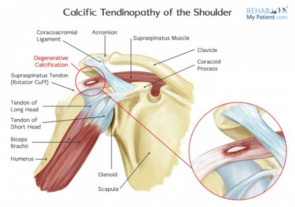 Calcific_tendinopathy_of_the_shoulder.jpg